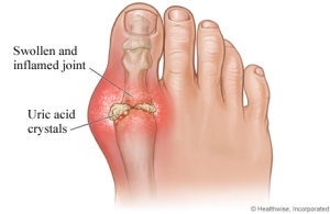 gout big toe